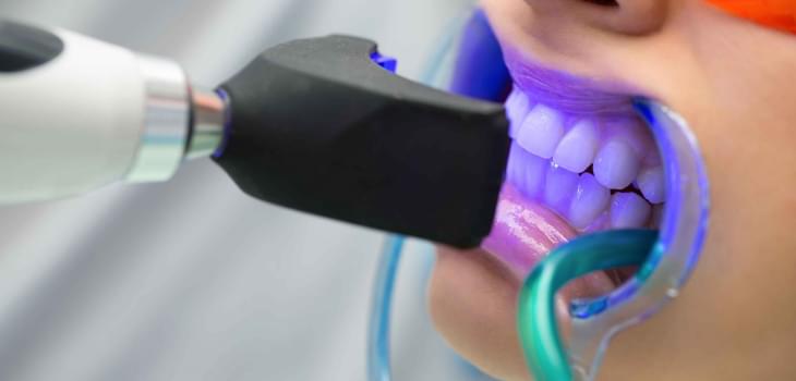 Clareamento Dental - Áquila Saúde